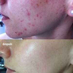 tratamiento de acné en la piel