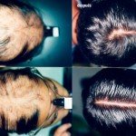 alopecia-areata2