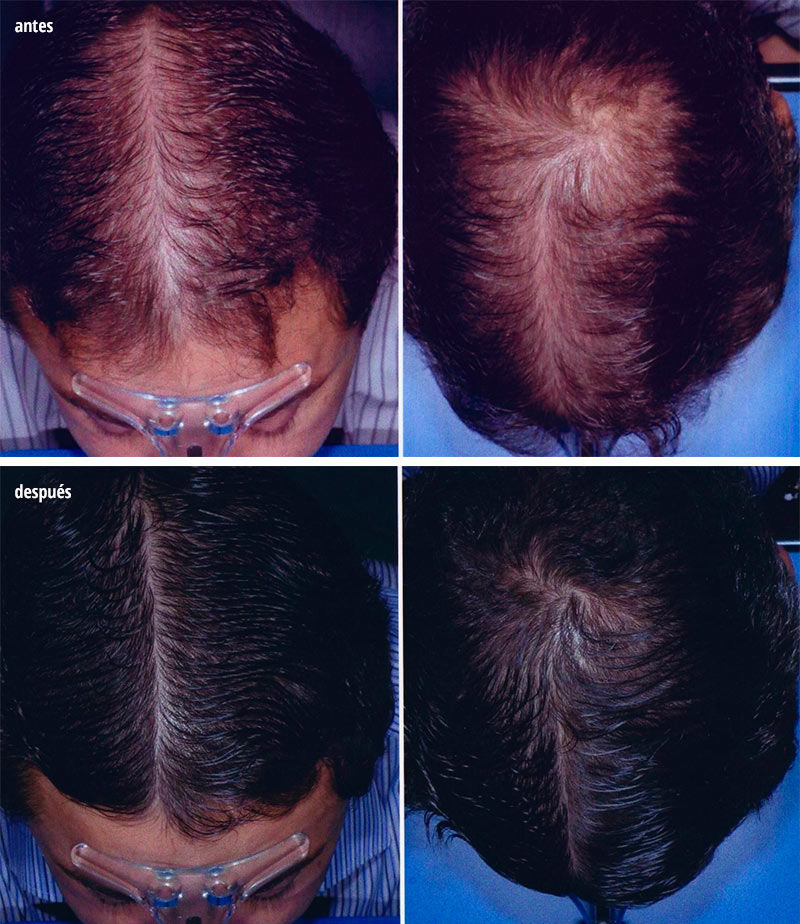 tratamiento alopecia femenina intensivo