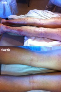 dermatitis atópica en piernas