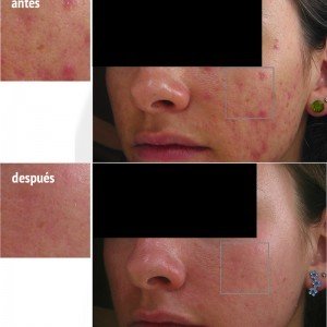 tratamiento de acné
