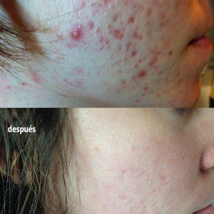 Mejora del acné tras tratamiento