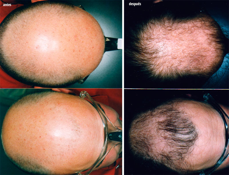 tratamiento especializado alopecia