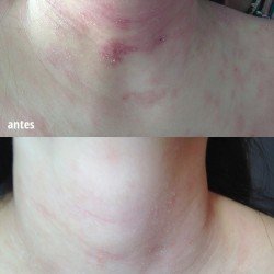 dermatitis atópica en cuello