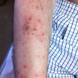ejemplo de dermatitis atópica