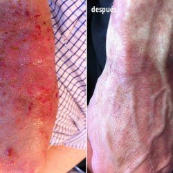 paciente afectado por dermatitis