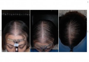 tratamiento alopecia a los 14 meses