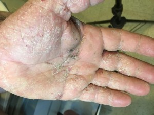 dermatitis en manos
