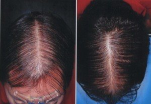tratamiento alopecia
