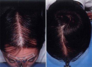 tratamiento alopecia resultados