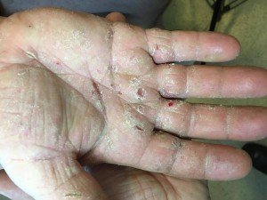 dermatitis en manos