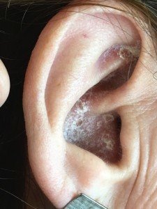 tratamiento dermatitis orejas