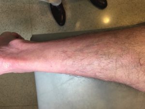 inflamación piernas