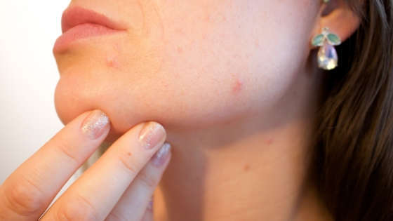 Alergia En La Cara Granitos