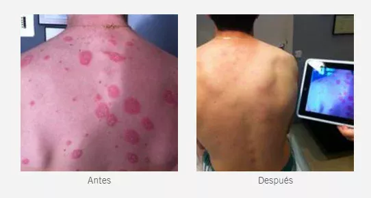 ¿Qué es la Psoriasis?