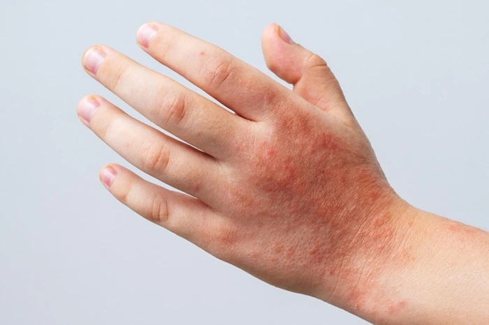duracion brote dermatitis atopica
