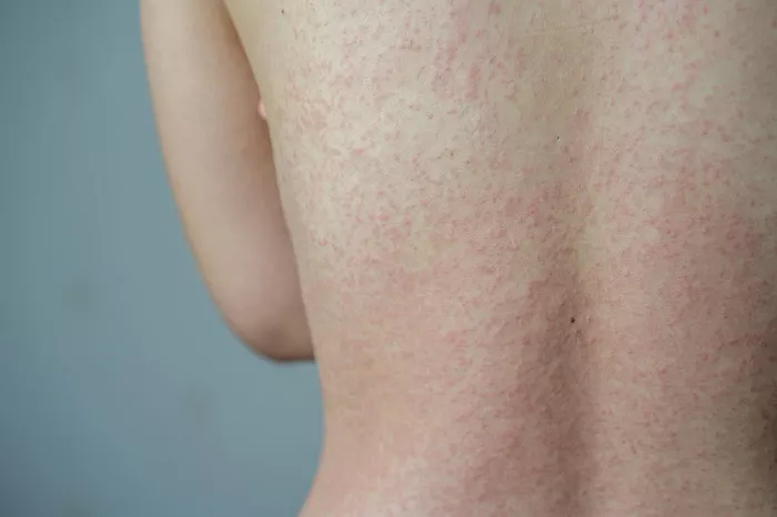 Manchas rosadas en la piel sin picor