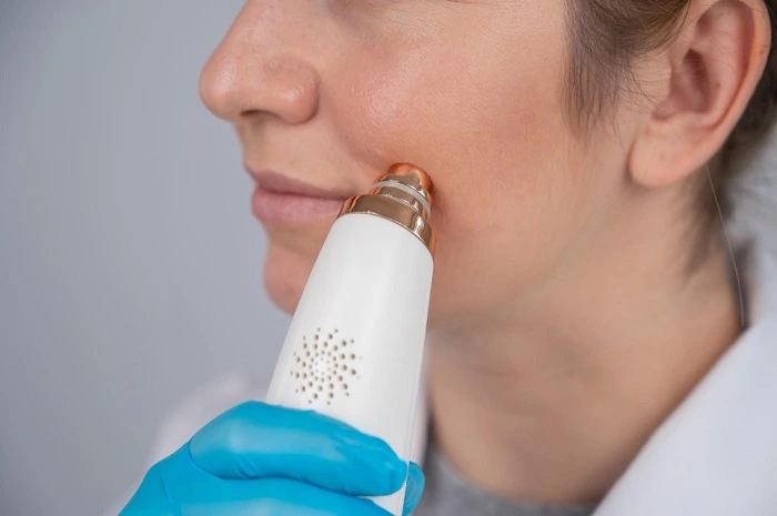 cuidados después láser para manchas