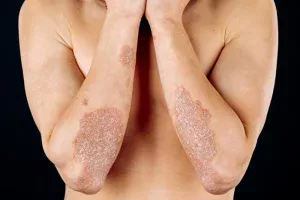psoriasis se contagia