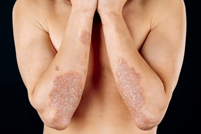 psoriasis se contagia