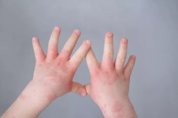 urticaria en niños