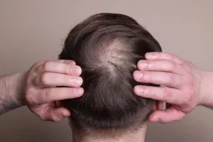 que es alopecia seborreica