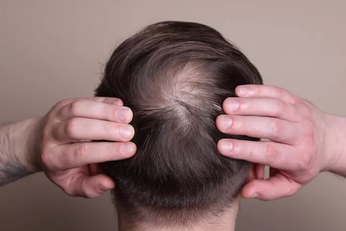 que es alopecia seborreica